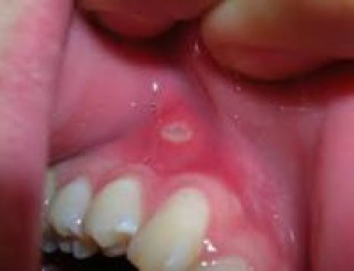 Are You at Risk for Bleeding Gums and Why Should You Care?